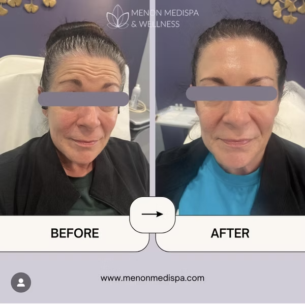 Before and after Botox treatment - forehead lines