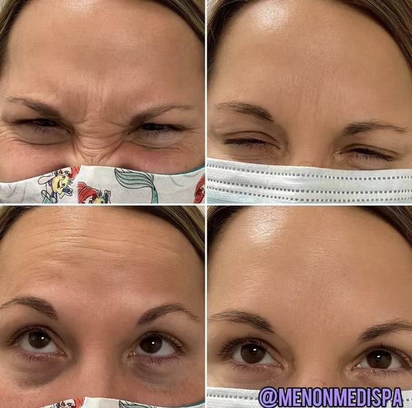 Before and after Botox - forehead wrinkle reduction